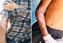 आदिवासी छात्रावास प्रबंधन की लापरवाही: रसोई में गर्म दाल से झुलसे 2 छात्र, परिजनों ने की कार्रवाई की मांग आदिवासी छात्रावास प्रबंधन की लापरवाही: रसोई में गर्म दाल से झुलसे 2 छात्र, परिजनों ने की कार्रवाई की मांग
