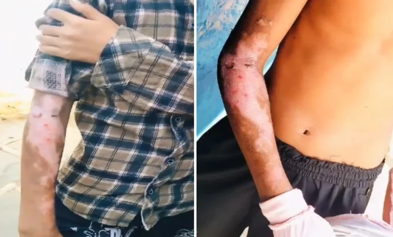 आदिवासी छात्रावास प्रबंधन की लापरवाही: रसोई में गर्म दाल से झुलसे 2 छात्र, परिजनों ने की कार्रवाई की मांग